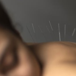 Dry needling: behandeling van triggerpoints met naalden